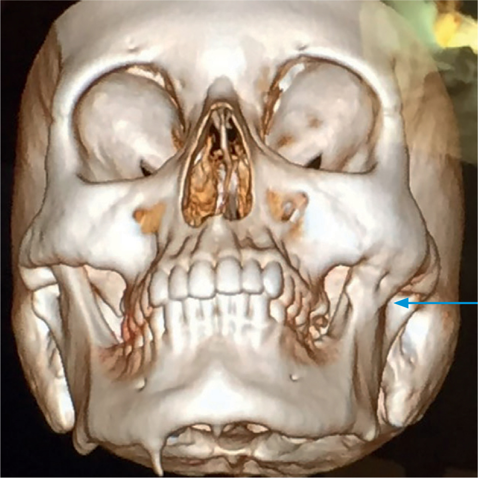 Complete trismus door fusie jukbeenboog met onderkaak